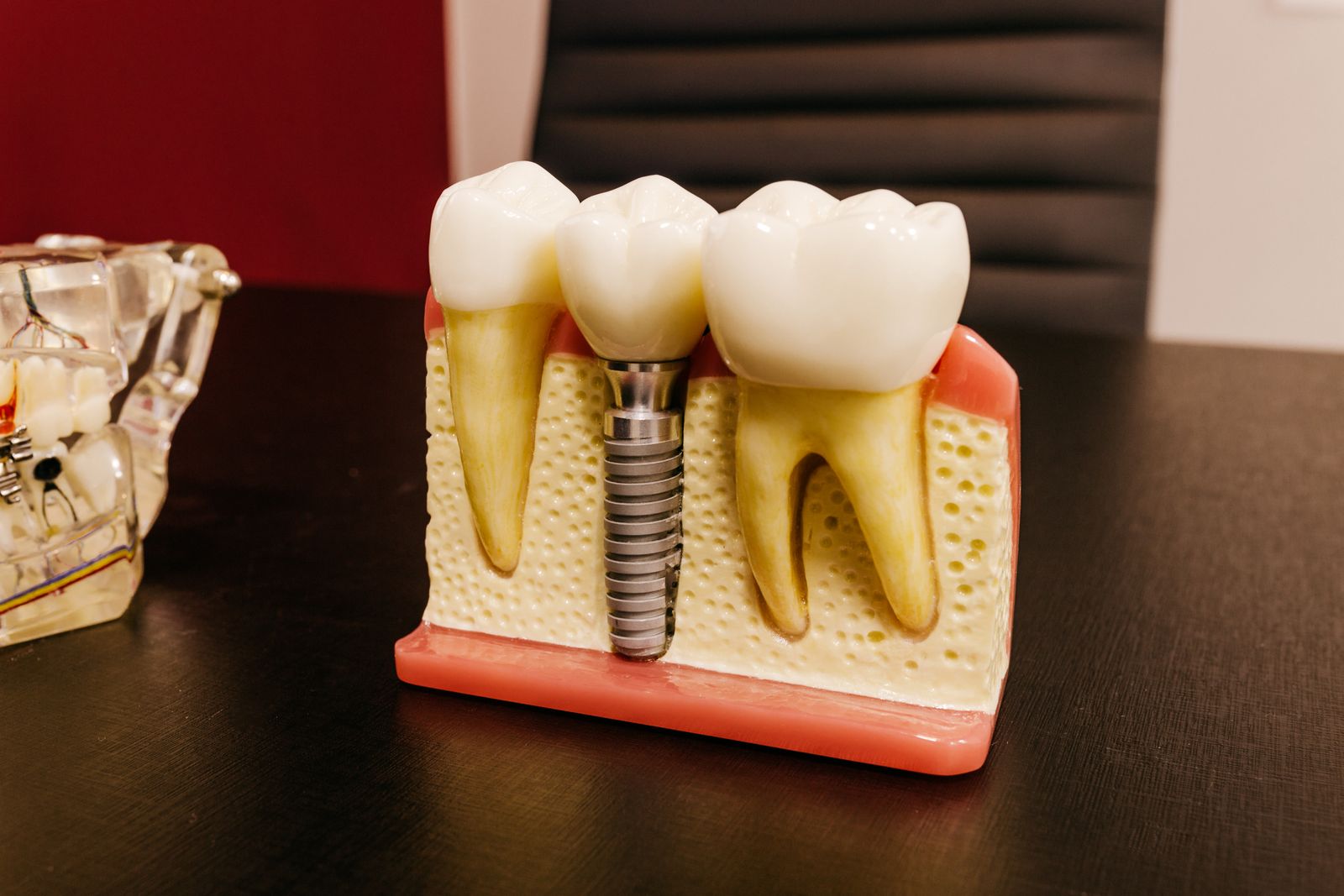Modelo de implante dental con tornillo de titanio