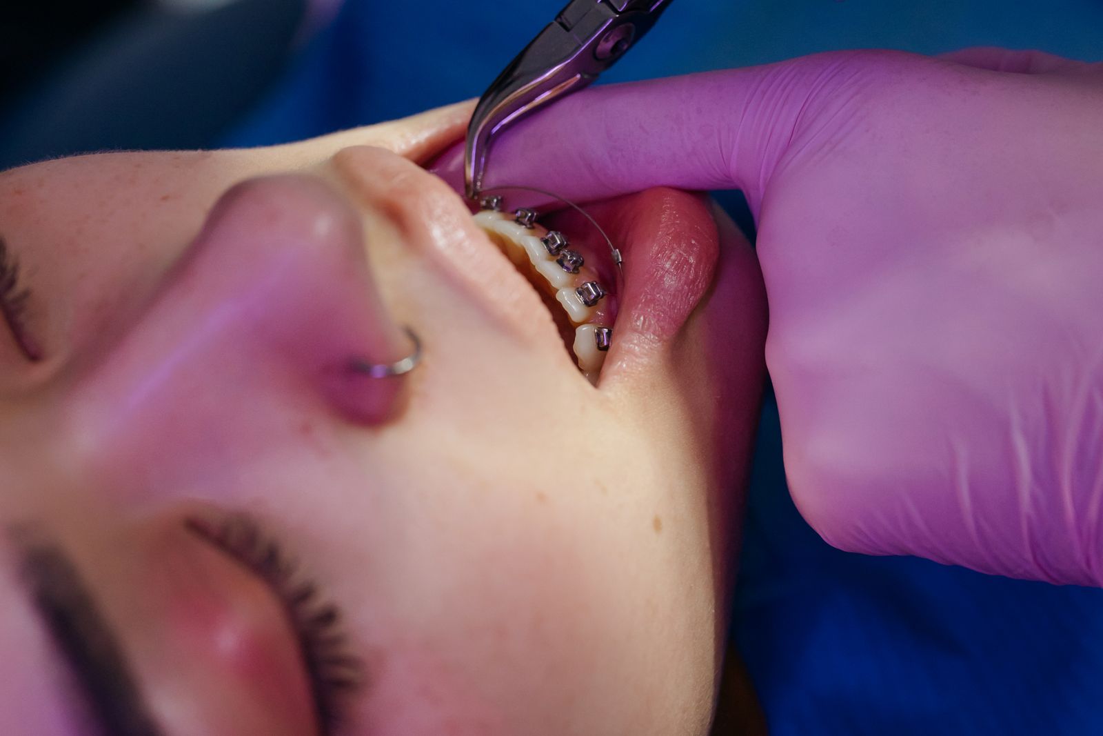 Colocación de brackets en un tratamiento de ortodoncia general